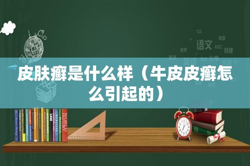 皮肤癣是什么样（牛皮皮癣怎么引起的）