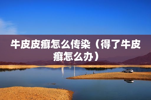 牛皮皮癣怎么传染（得了牛皮癣怎么办）