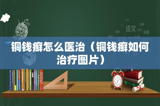 铜钱癣怎么医治（铜钱癣如何治疗图片）
