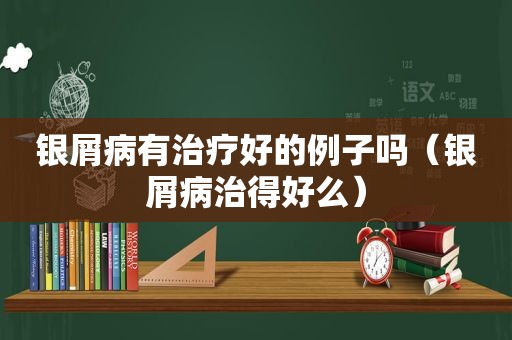银屑病有治疗好的例子吗（银屑病治得好么）